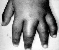Abb. 7: Kinderhand